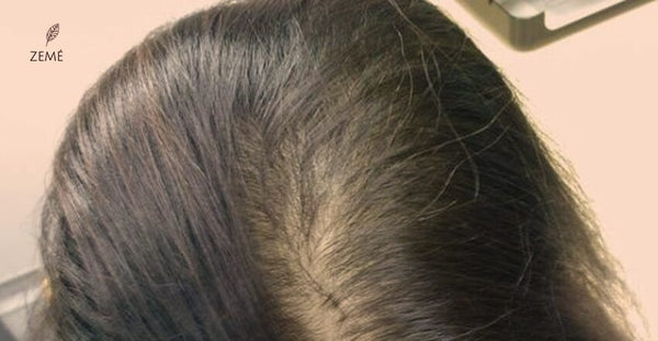 Hair Thinning Problems : Causes & Cures