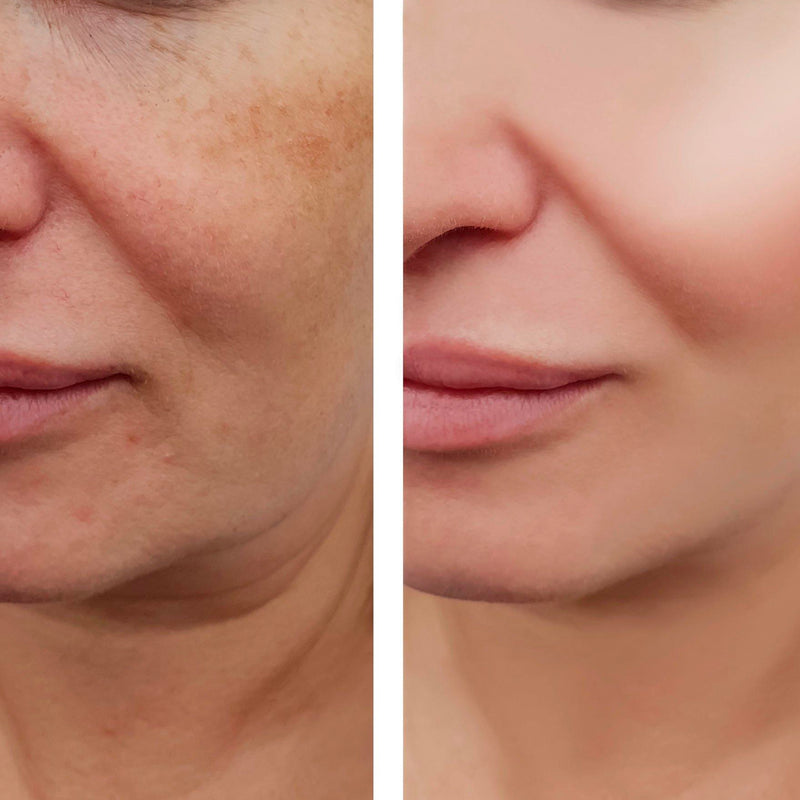 Anti-Pigmentation Facial for All Skin Types - 60 minutes